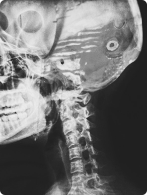Brain Injuries